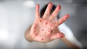 Az oltásellenesség bűn a gyerekekkel szemben - a kanyarós esetek száma a duplájára nőt